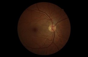 ep glaucoma