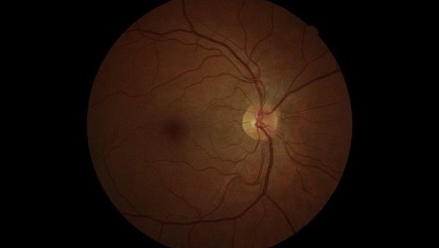 ep glaucoma