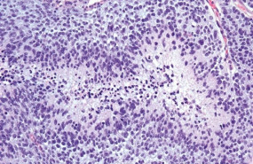 ep tejidoglioblastoma