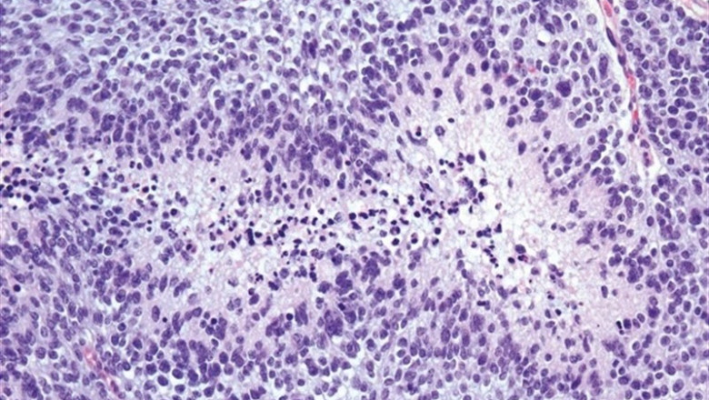 Tejido de glioblastoma | CNIO - Archivo ep tejidoglioblastoma