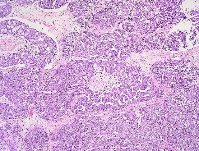 Cáncer de ovario | FLICKR/ED UTHMAN - Archivo ep cancerovario 20180503150709