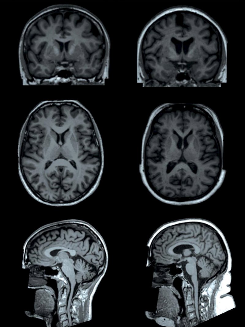 ep resonancias magneticas del cerebro