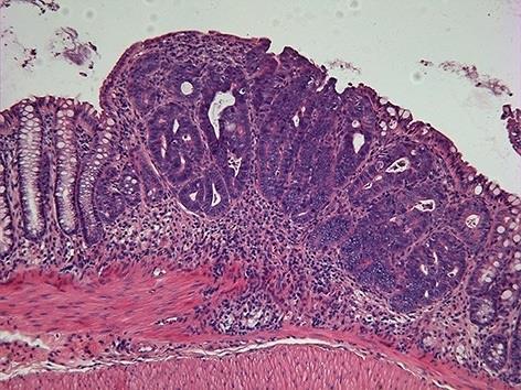 ep tumorcolon cancer