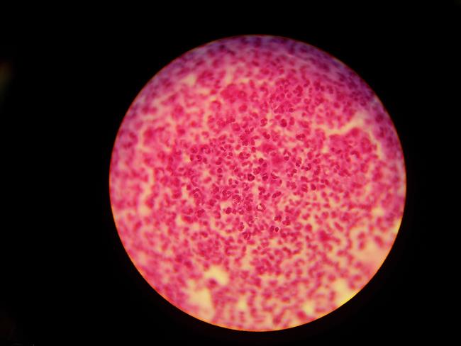 Gonorrea, Neisseria gonorrhoeae | FLICKR/PUSH0K ep gonorrea neisseria gonorrhoeae