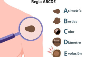 1 ndp callo solar melanoma 1 