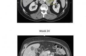 ep cancerprostata