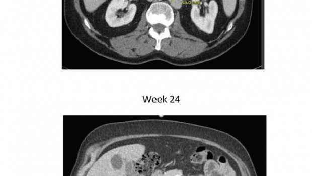 ep cancerprostata