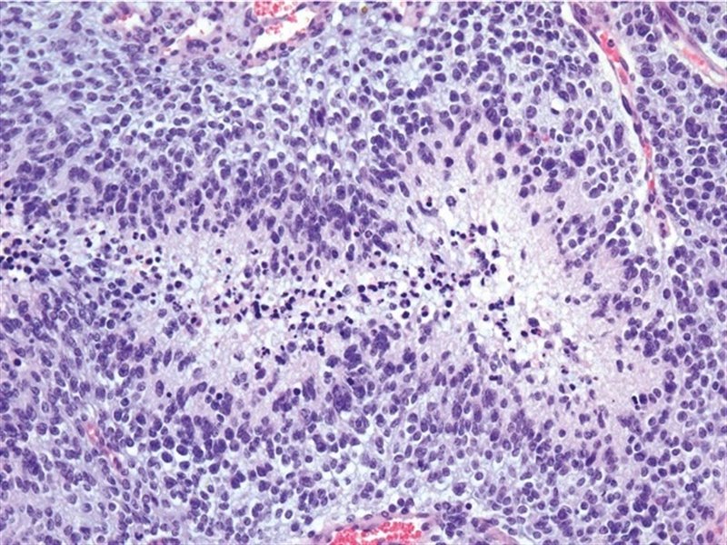 ep tejido de glioblastoma
