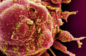 ep micrografia electronica de barrido coloreada de una celula apoptotica en rojo infectada con