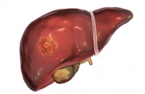 ep estudioinvestigadoresla uscmetastasis hepatica