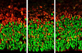 ep la imagen muestra celulas cerebrales con niveles bajos de funcion foxp1 a la izquierda y niveles