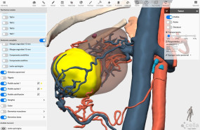 modelo 3d renal cella medical solutions 1 2