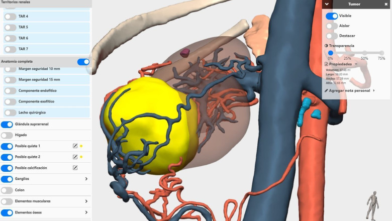 modelo 3d renal cella medical solutions 1 2