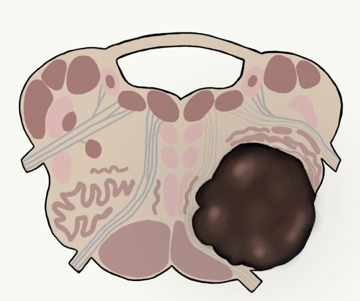ep gliomas de alto grado en el tronco cerebral
