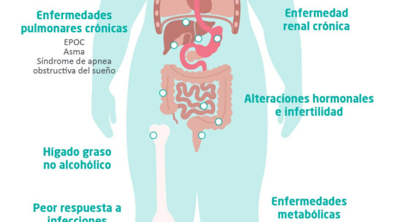 ndp dia mundial de la obesidad 