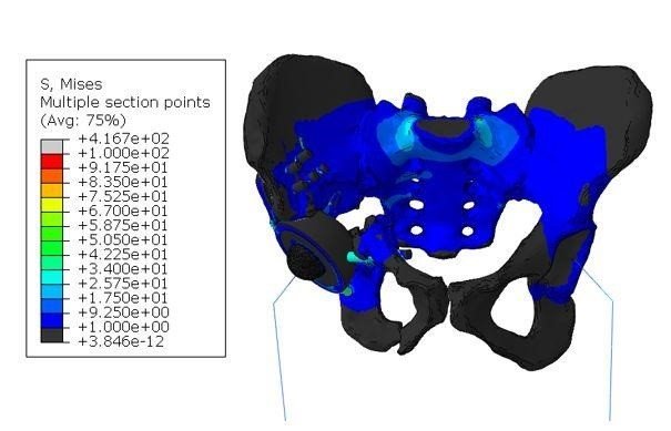 Distribución general de tensiones en el modelo "endoprótesis-esqueleto" de la estructura biomecánica cuando el paciente está de pie sobre dos piernas. | PETER THE GREAT ST.PETERSBURG POLYTECHNIC ep distribucion general de tensiones en el modelo endoprotesis-esqueleto de la estructura