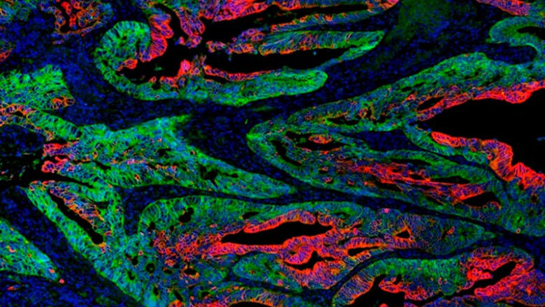 ep la capacidad biosintetica es clave para erradicar celulas madre tumorales segun un estudio ep la capacidad biosintetica es clave para erradicar celulas madre tumorales segun un estudio