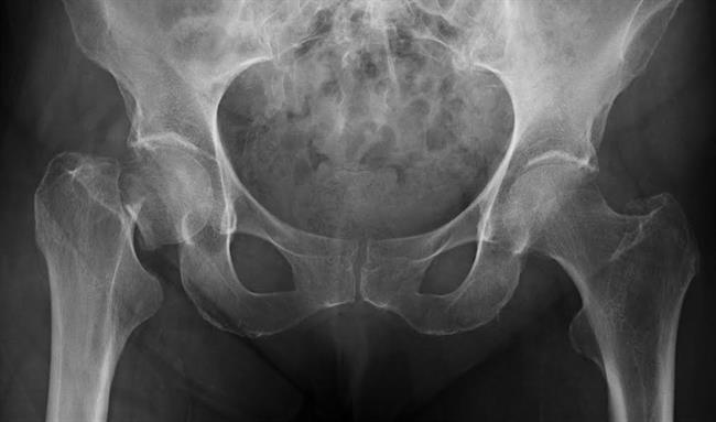 ep radiografiacadera