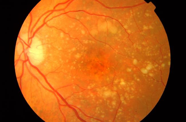Retina con DMAE | IMO ep retinadmae