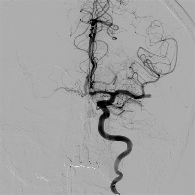 Imagen de arteria obstruida con trombo | CEDIDA ep imagenarteria obstruidatrombo