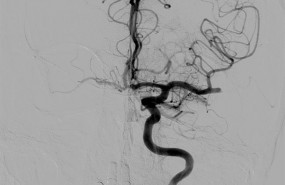 ep imagenarteria obstruidatrombo