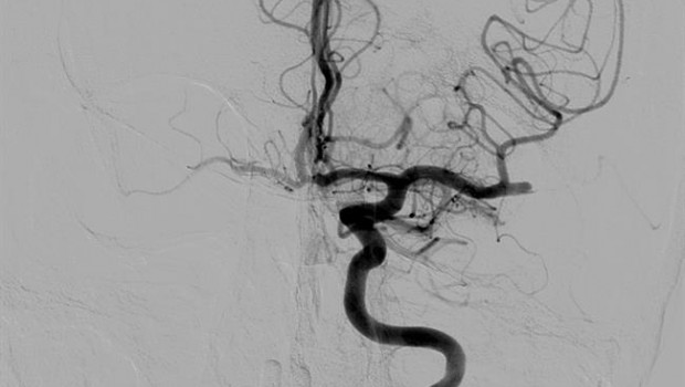 ep imagenarteria obstruidatrombo