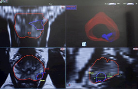 ep biopsia de prostata por fusion