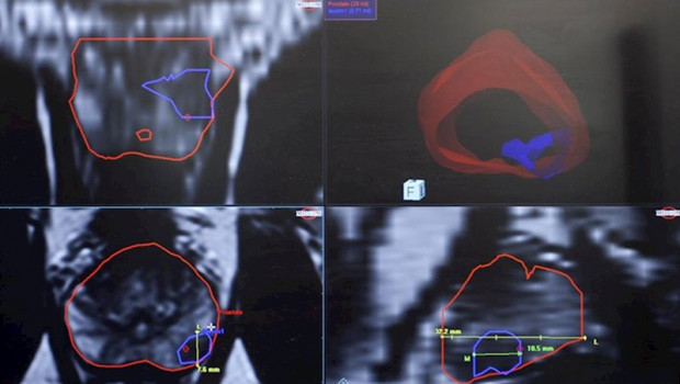 ep biopsia de prostata por fusion