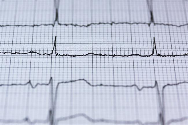 Electrocardiograma | PIXABAY ep electrocardiograma