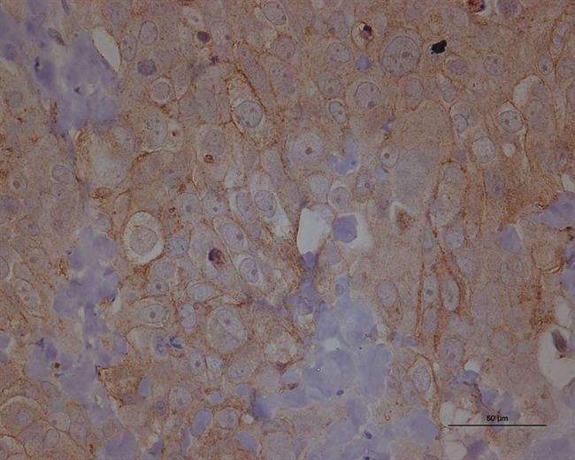 Metástasis cáncer de ovario | IDIBELL-ICO - Archivo ep metastasis cancerovario