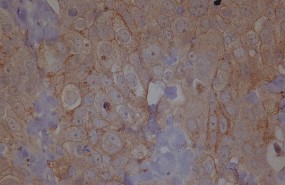 ep metastasis cancerovario