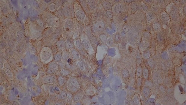 ep metastasis cancerovario