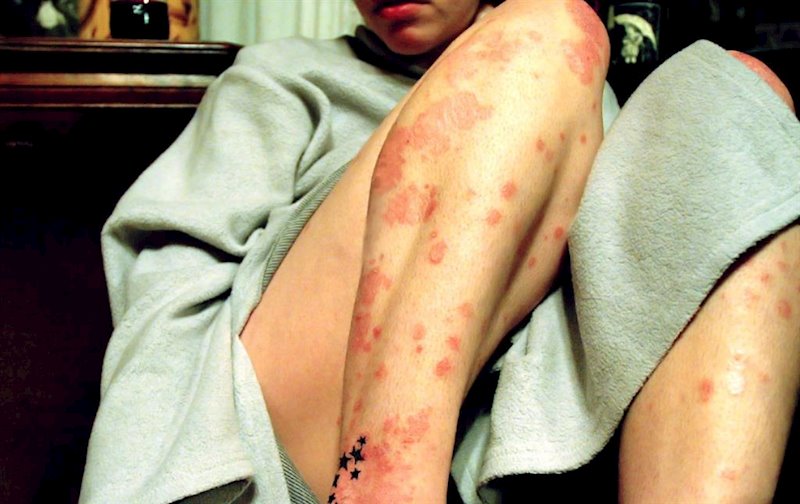 ep dermatitis