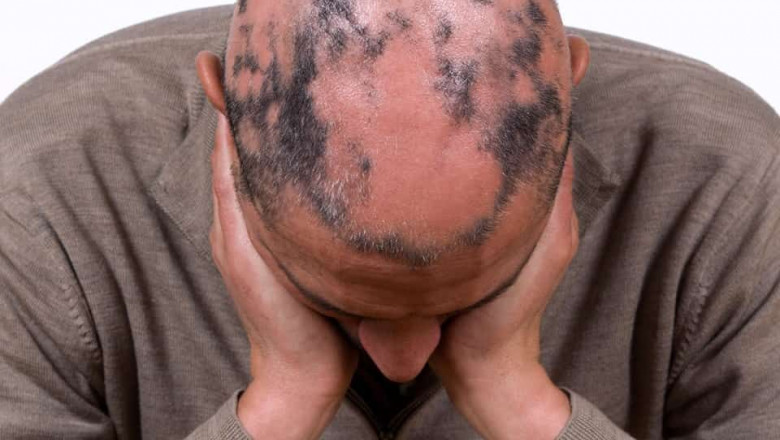 1599770593 efectos secundarios cirugia min