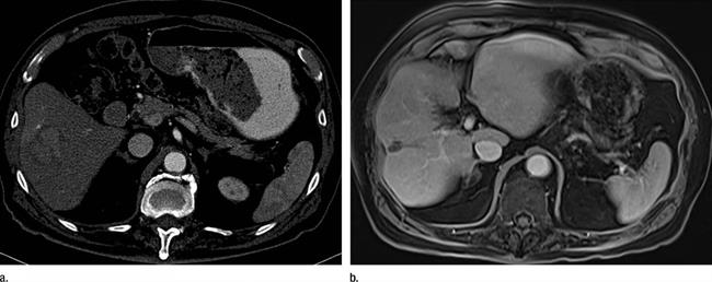 ep cancerhigado