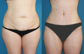 1628841181 antes despues 5b vaser lipo alicante 1628841181 antes despues 5b vaser lipo alicante