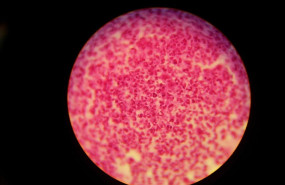 ep gonorrea neisseria gonorrhoeae 20190806170504