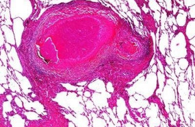 ep imagen de tejido pulmonar de un enfermo de tuberculosis