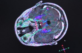 ep radiografias electroencefalogramas actividadcerebro tumor