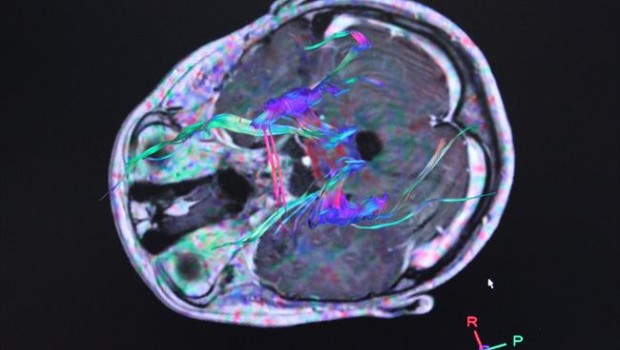 ep radiografias electroencefalogramas actividadcerebro tumor
