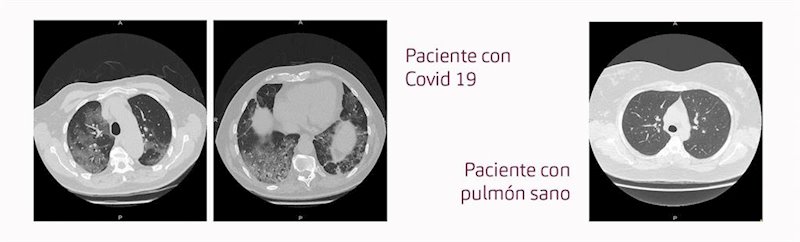 ep pulmones de un paciente con covid-19