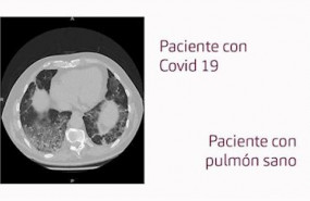 ep pulmones de un paciente con covid-19