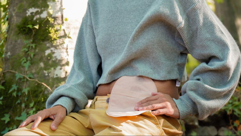 paciente ostomizado 