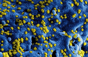 ep micrografia electronica de escaneo a color de las particulas del virus del sindrome respiratorio