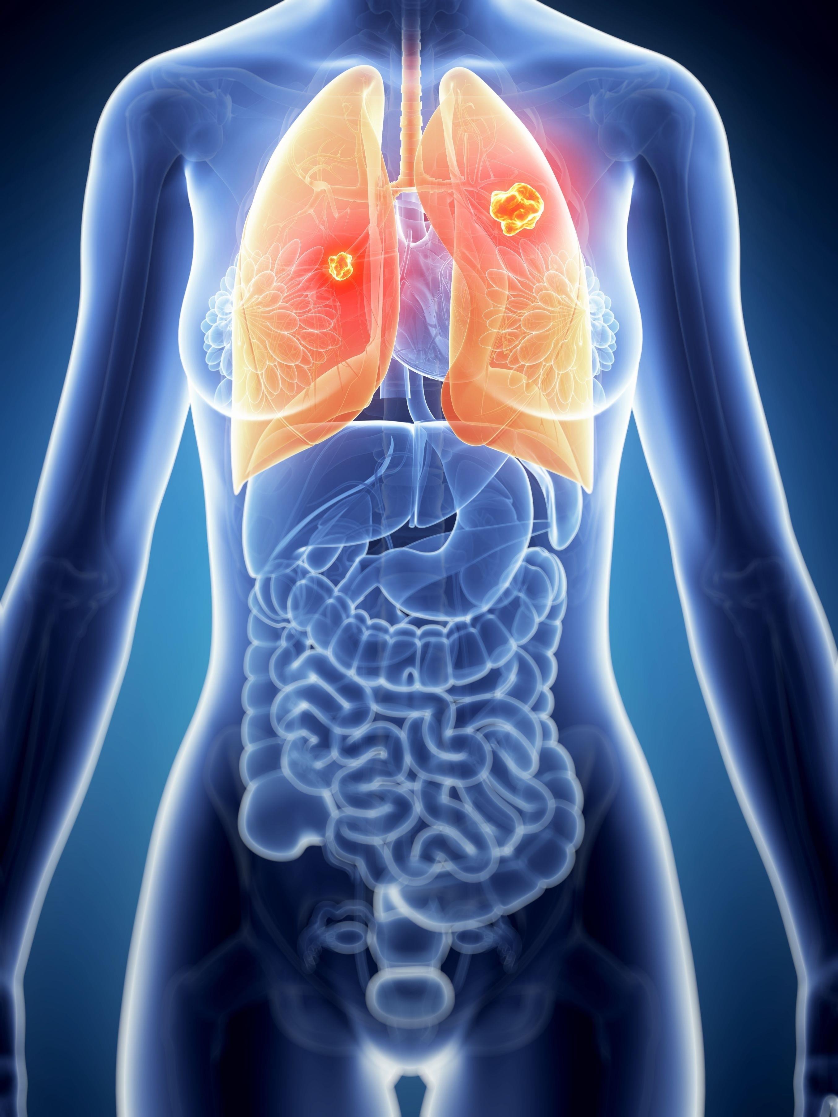 19040628 - 3D Rendered Illustration Of The Female Anatomy - Lung Cancer | HLA GRUPO HOSPITALARIO ep 19040628 - 3d rendered illustration of the female anatomy - lung cancer